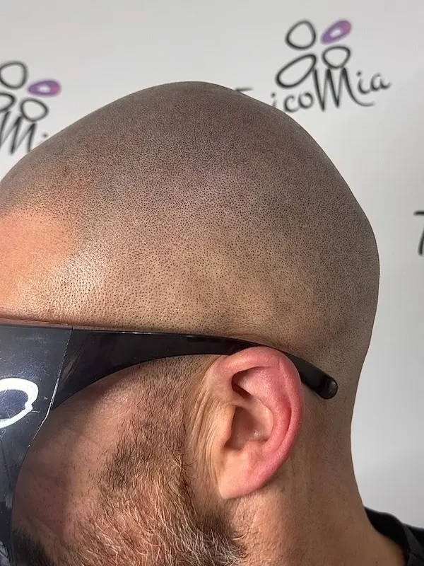 Tricopigmentazione,  prima, dopo e… durante. Cosa aspettarsi davvero