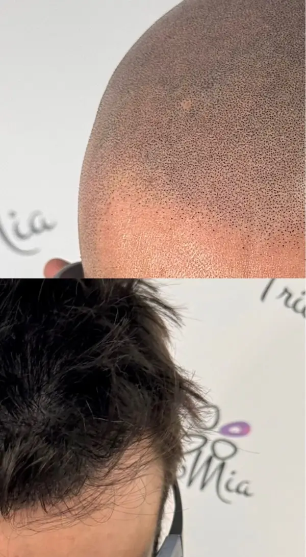 Tricopigmentazione o Trapianto di Capelli?