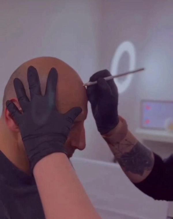 La Tricopigmentazione è un trattamento Personalizzato o Standardizzato?